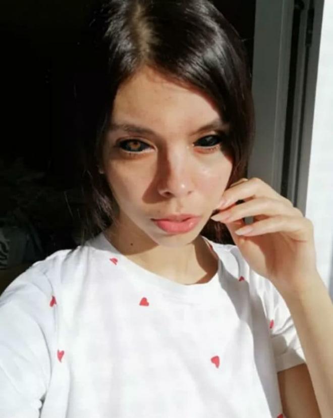 Cô gái bị mù sau khi xăm mực đen lên nhãn cầu để giống thần tượng 4 Cô gái bị mù sau khi xăm mực đen lên nhãn cầu để giống thần tượng 4