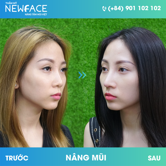 Viện thẩm mỹ Newface, Phẫu thuật thẩm mỹ, Nâng mũi