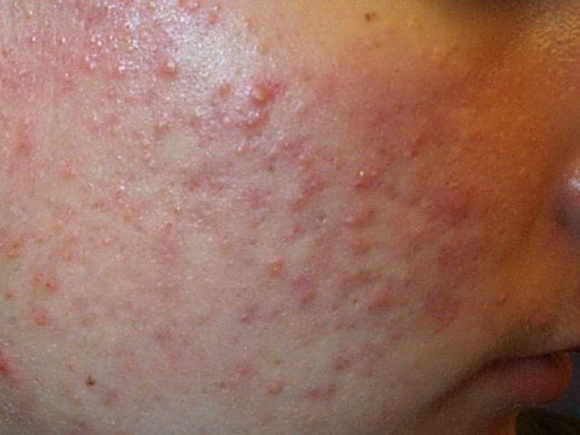 Mụn trứng cá, điều trị mụn