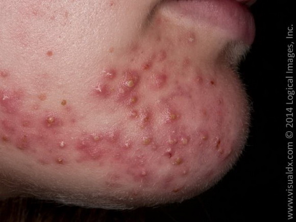Mụn trứng cá, điều trị mụn