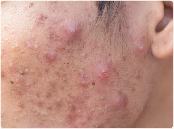 Mụn trứng cá, điều trị mụn