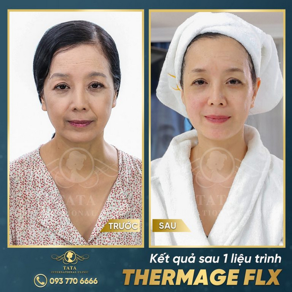 Tata Clinic, Trị vết chân chim quanh mắt, căng chỉ Collagen