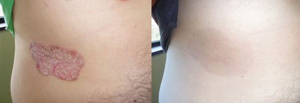vảy nến thể mảng, điều trị vảy nến, phòng khám Dr. Michaels Psoriasis & Skin Clinic