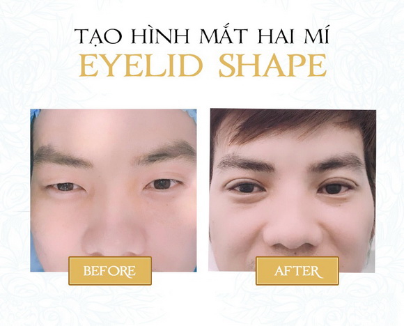 Tạo hình mắt hai mí, SHE CENTER, EYELID SHAPE, CEO Đỗ Thị Thu Mai