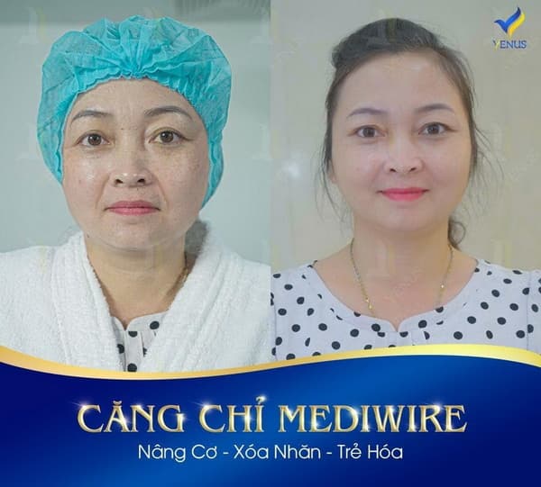 Thẩm Mỹ Viện Quốc Tế Venus, Căng da Mediwire, Trẻ hóa da