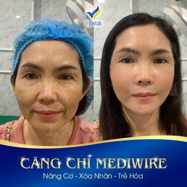 Thẩm Mỹ Viện Quốc Tế Venus, Căng da Mediwire, Trẻ hóa da