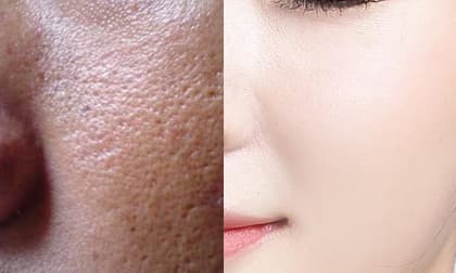 Melasma-x 3D Whitening Clinic Cream, mỹ phẩm hàn quốc, nám da