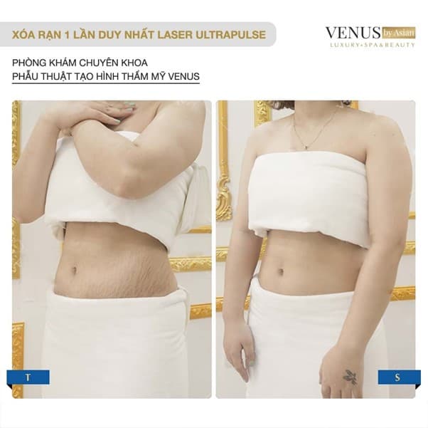 Trị rạn da, Phòng khám chuyên khoa Phẫu thuật tạo hình thẩm mỹ Venus, Venus by Asian