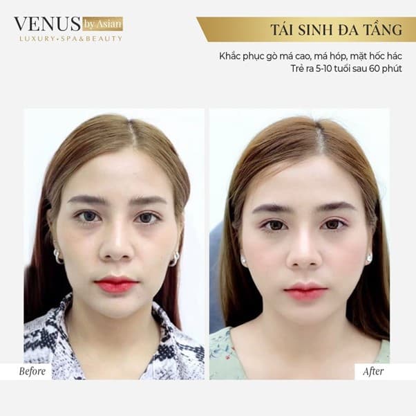Tái sinh đa tầng, Phòng khám chuyên khoa Phẫu thuật tạo hình thẩm mỹ Venus, Venus by Asian