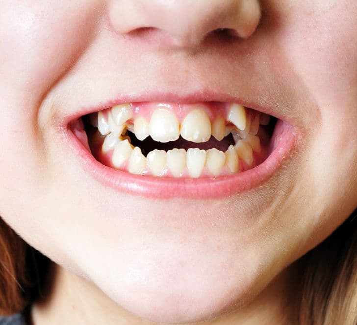 வாய் சுவாசம் குழந்தைகளுக்கு கொண்டு வரக்கூடிய பிரச்சனைகள் 4 Trẻ thường há miệng khi ngủ, đây là điều bé có thể phải đối mặt trong tương lai