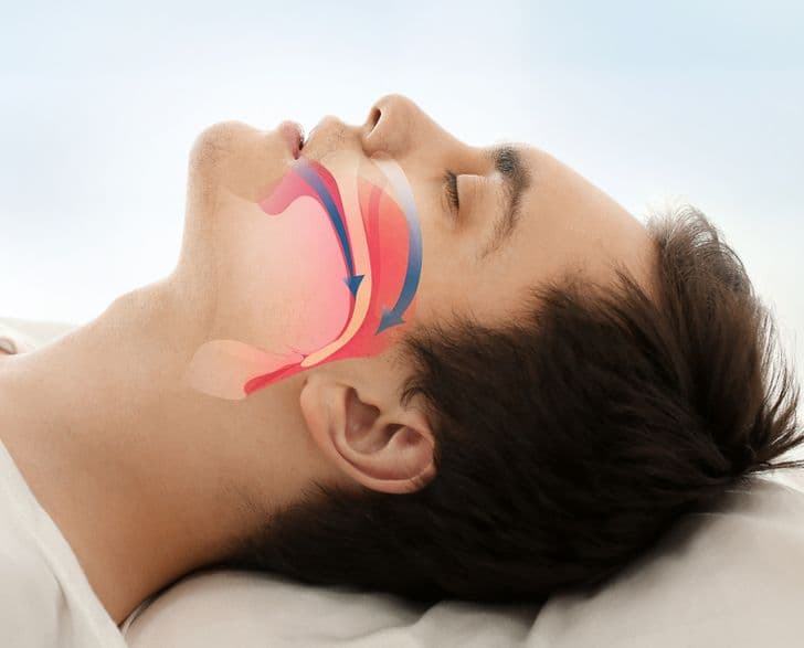 வாய் சுவாசம் குழந்தைகளுக்கு கொண்டு வரக்கூடிய பிரச்சனைகள் 2 Trẻ thường há miệng khi ngủ, đây là điều bé có thể phải đối mặt trong tương lai