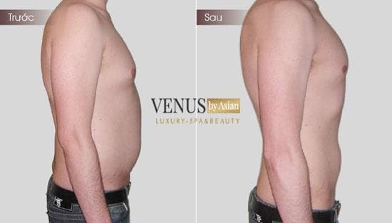 Giảm béo đa tầng MaxBurning, Thẩm mỹ Venus by Asian, giảm cân