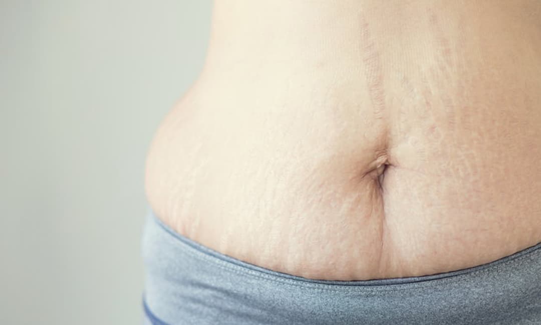 5 cách đơn giản giúp giảm mỡ bụng sau sinh để vòng eo phẳng lì nhanh chóng