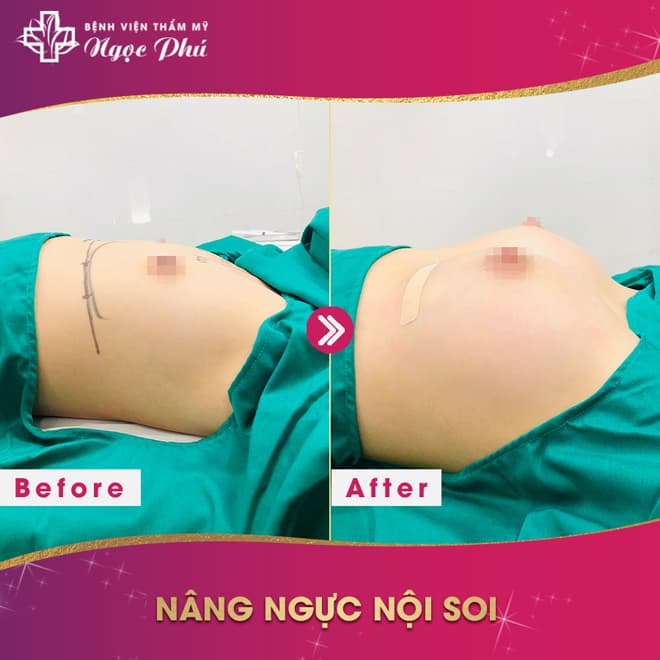 nâng ngực nội soi, Bệnh viện Thẩm mỹ Ngọc Phú, Phẫu thuật thẩm mỹ
