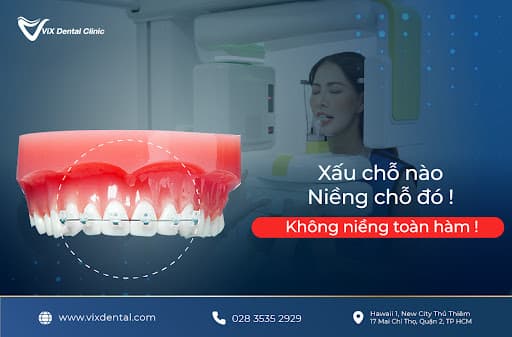 niềng răng cửa chọn lọc, Nha Khoa VIX, sức khỏe răng miệng, VIX Dental Clinic