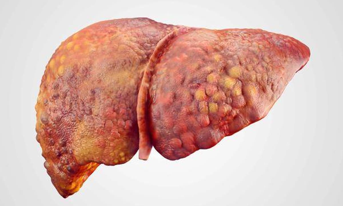 Đã tìm ra nguyên nhân lớn nhất gây ung thư gan và phổ biến gấp 10 lần thuốc lá, rượu. Lưu ý: Tránh ăn những thực phẩm này càng sớm càng tốt