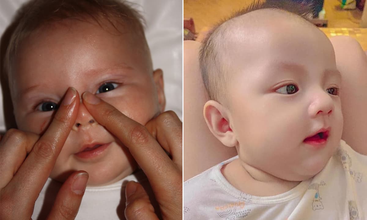View - Trẻ mới sinh ra bị mũi tẹt, cha mẹ có nên vuốt lên cho cao không? Chuyên gia tiết lộ sự thật!