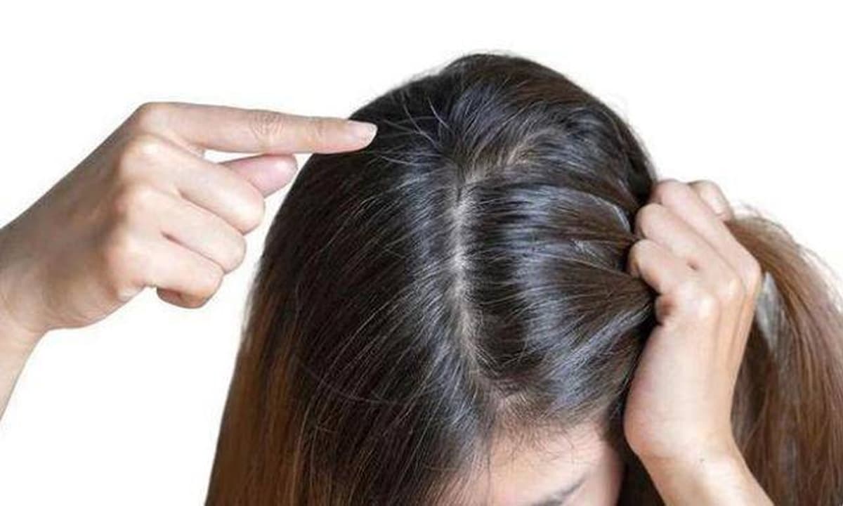 View - Thiếu vitamin nào sẽ khiến tóc bạc sớm? Tóc bạc có nhổ được không? Bạn sẽ hiểu sau khi đọc bài viết này 