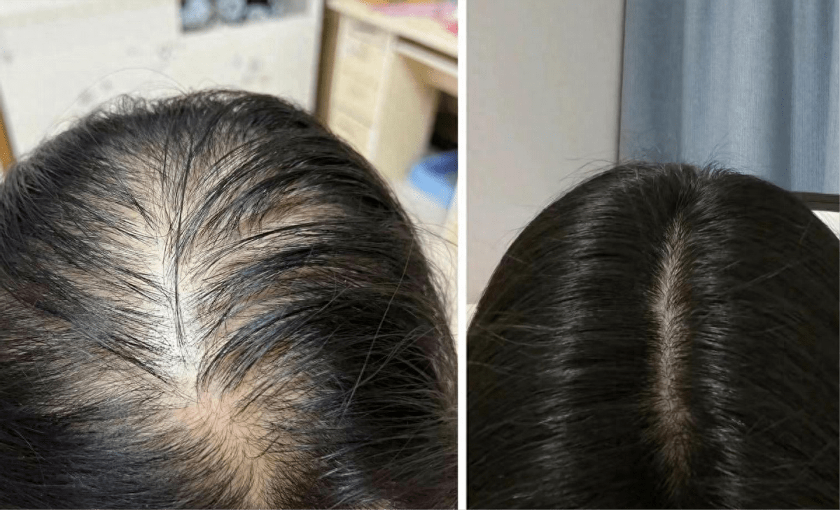 Rụng tóc khi gội đầu ở nam: Nguyên nhân và cách trị