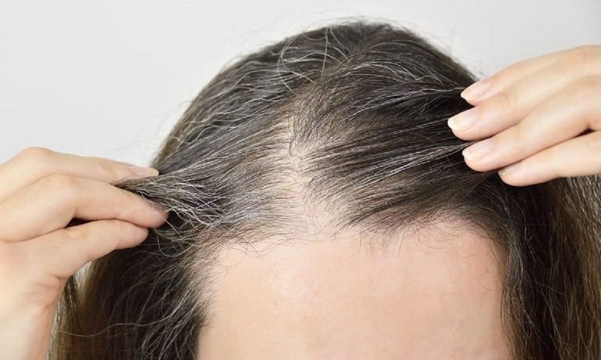 View - Thiếu vitamin nào sẽ gây ra tóc bạc ở cơ thể con người? Làm thế nào để ngăn ngừa tóc bạc xuất hiện?