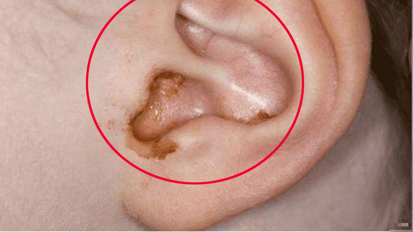 Tại sao có người có ráy tai ướt, có người có ráy tai khô? 4 vấn đề này có thể tồn tại