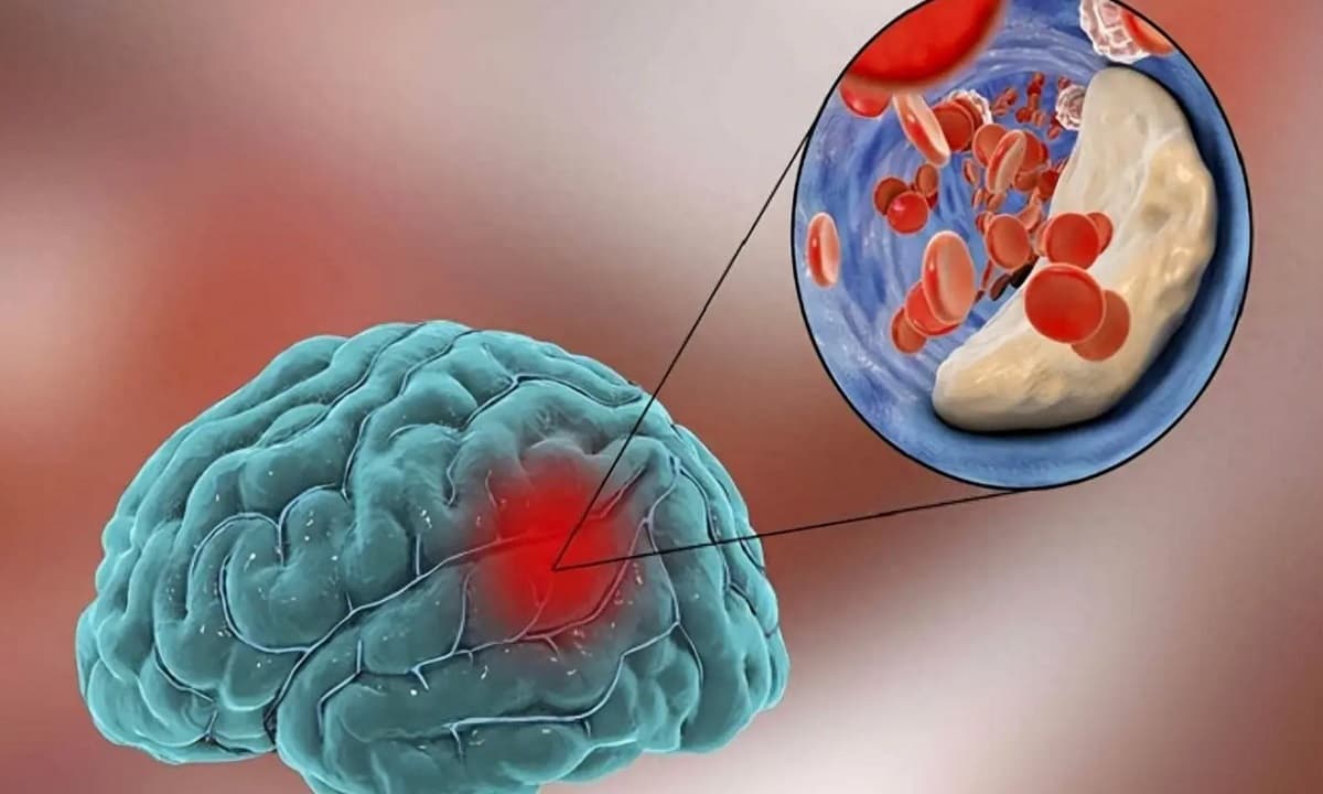 Đã tìm ra 'nguồn gốc' của nhồi máu não: Thịt mỡ không có trong danh sách, thực phẩm số 1 là thứ mà mọi người có thể ăn hàng ngày!