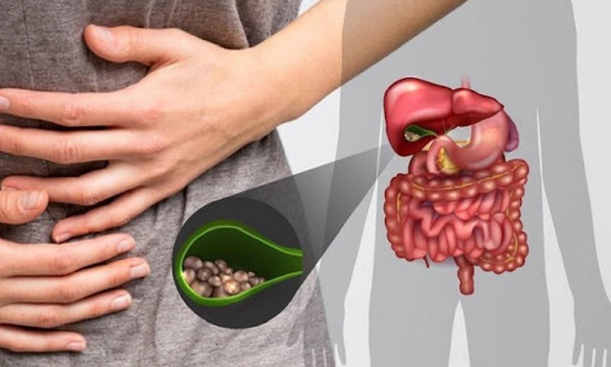 Tại sao sỏi mật lại thường gặp ở phụ nữ? Nó thường liên quan mật thiết đến cuộc sống hàng ngày. Năm loại thói quen có khả năng gây ra bệnh cao nhất