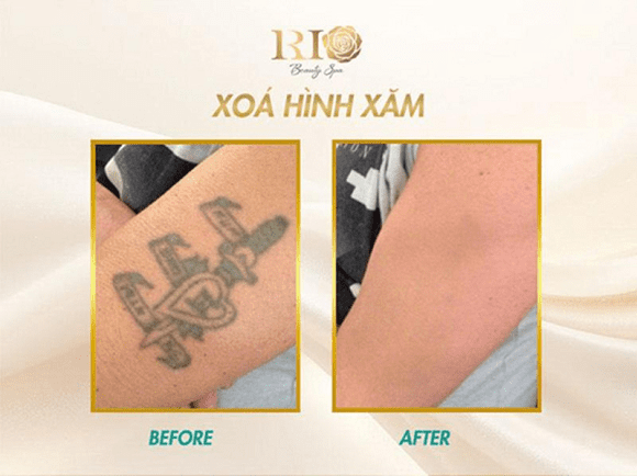 Xoa-hinh-xam-1.png 0 xóa hình xăm, Thẩm Mỹ Rio Beauty Clinic