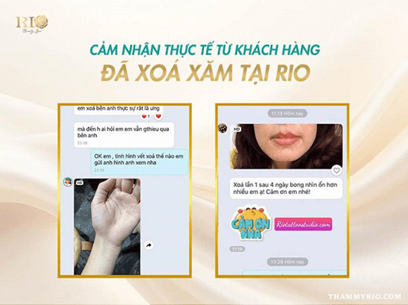 Xoa-hinh-xam-3.png 0 xóa hình xăm, Thẩm Mỹ Rio Beauty Clinic
