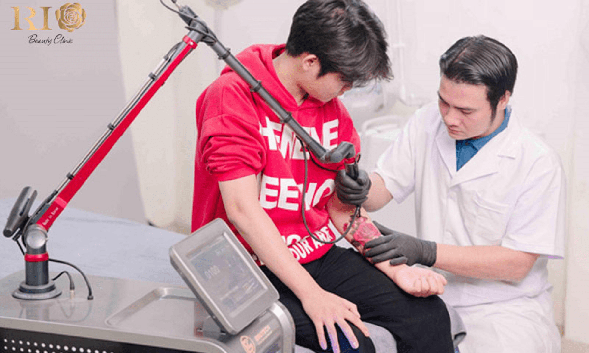 Xóa hình xăm ở đâu uy tín và không để lại sẹo?