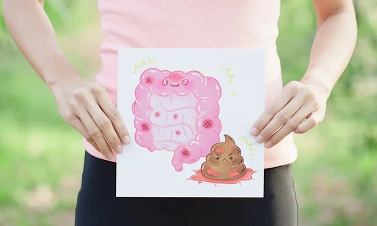 Làm thế nào để phân biệt chảy máu do trĩ và chảy máu trực tràng do ung thư đại trực tràng? Bác sĩ sẽ hướng dẫn bạn cách phân biệt