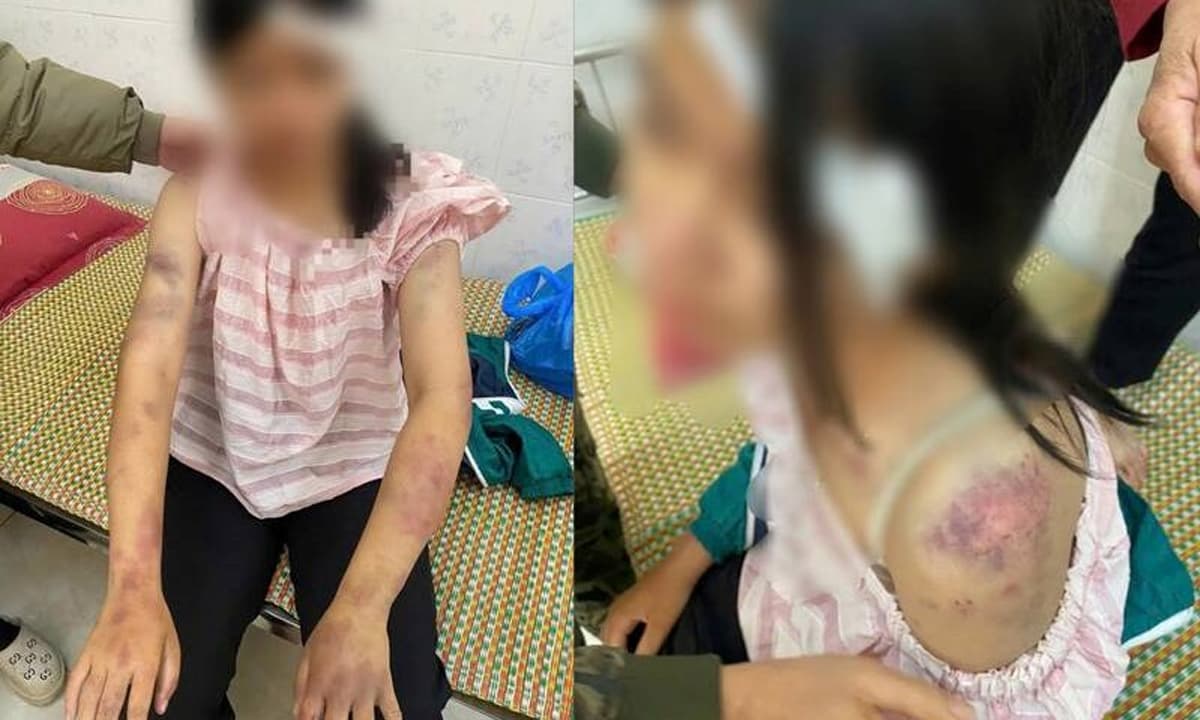 Vụ bé gái 13 tuổi bị bạo hành: Hé lộ kết quả giám định thương tích, 3 người thân bị khởi tố