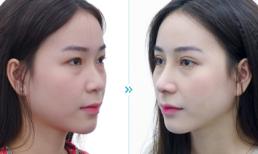 Viện thẩm mỹ Newface giúp cô gái Sài thành “lột xác thần kỳ” bằng Go-tex