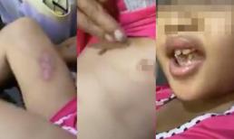 Tạm giữ cha dượng và mẹ của bé gái 6 tuổi bị hành hạ, châm thuốc lá vào người ở Sài Gòn