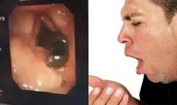 Ho 2 tháng không khỏi, hóa ra có 2 con đỉa sống trong cổ họng