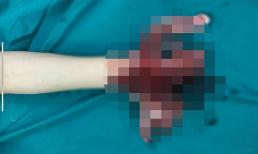 Điện thoại phát nổ khi cắm sạc dự phòng, nam sinh ở Thanh Hoá bị nát toàn bộ bàn tay