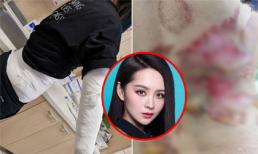 Mỹ nhân 'Diên Hy công lược' bị bỏng nặng vì giác hơi