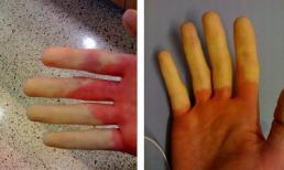 Nếu tay chân bị tê và đổi màu trong thời tiết lạnh có thể là dấu hiệu của bệnh cực nguy hiểm