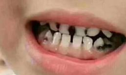 Miệng bé 3 tuổi đầy 'răng đen', không phải vì đường, mà là hai thói quen này của nhiều bố mẹ