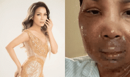 Hồng Ngọc chính thức chia sẻ hình ảnh cận mặt sau vụ nổ nồi áp suất tại Mỹ