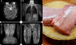 Ăn thịt lợn chưa được nấu chín, chàng trai Thái Lan 18 tuổi bị sán dây ký sinh trắng xóa khắp người
