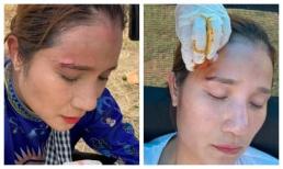 Cát Tường bị tai nạn phim trường, khâu 3 mũi ở chân mày 