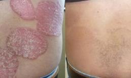 Kiểm soát hiệu quả bệnh vẩy nến bằng kết hợp thảo dược