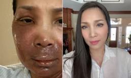 Hồng Ngọc tiết lộ sống trong sự lo lắng mỗi ngày dù đã bình phục sau tai nạn bỏng 