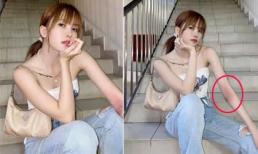 Thiều Bảo Trâm lộ cánh tay đỏ ửng, sưng tấy, dân mạng đua nhau đoán nguyên nhân
