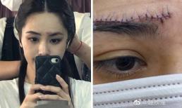 Hình ảnh vết thương kinh hoàng ở vùng trán của Chung Hân Đồng được công bố