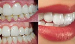 Dành 3 phút buổi tối làm điều này, cả đời chẳng phải đến nha sỹ lấy cao răng