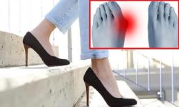Chú ý! 30% phụ nữ mắc bệnh ở chân. Bác sĩ khuyến cáo: 'Hạn chế đi giày kiểu này?'