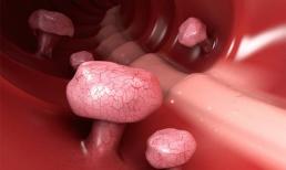 Thủ phạm của bệnh polyp đại trực tràng cuối cùng đã được tìm thấy. Chỉ bằng cách làm tốt 4 điều buổi sáng ruột sẽ tốt hơn