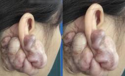 Hình ảnh sẹo đùn kín tai do nâng mũi bằng sụn tai gây sốc trên MXH: Có hay không việc sửa mũi đẹp xong khiến tai bị dị dạng?